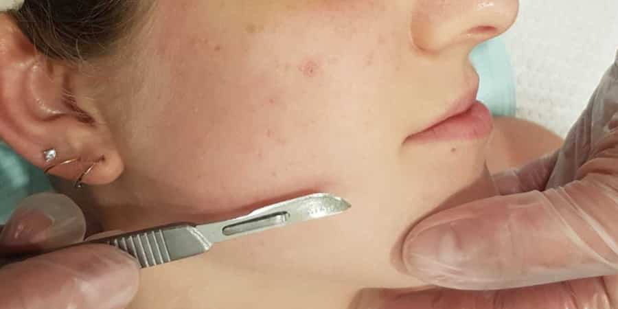 10 How Dermaplaning Can Benefit You