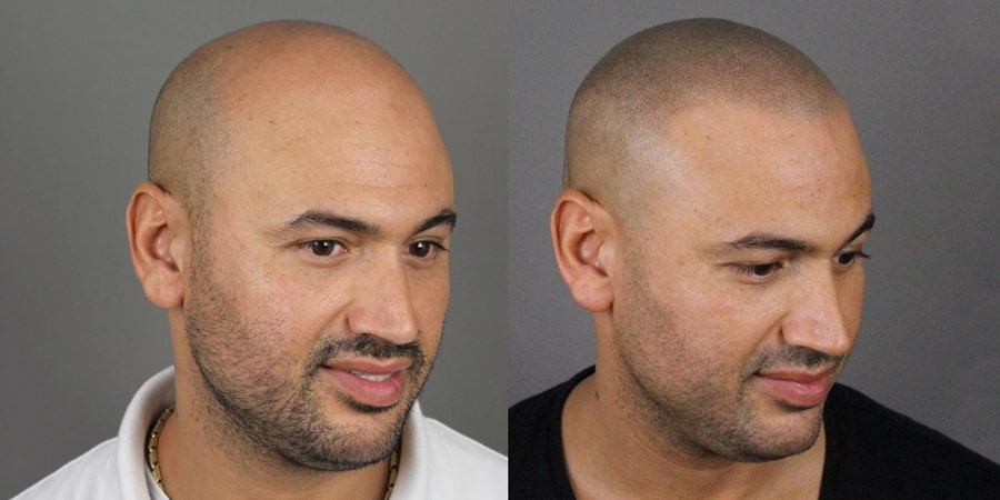 5 How Scalp Tattooing Can Help Bring Back Your Confidence